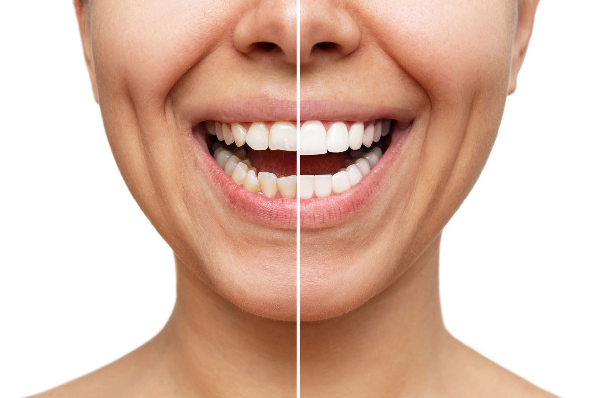 how-much-are-porcelain-veneers