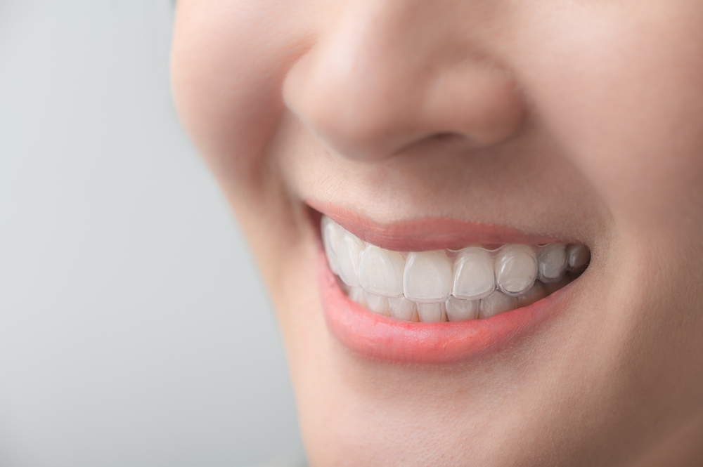 Woman,Wearing,Orthodontic,Silicone,Trainer.,Mobile,Orthodontic,Appliance,For,Dental